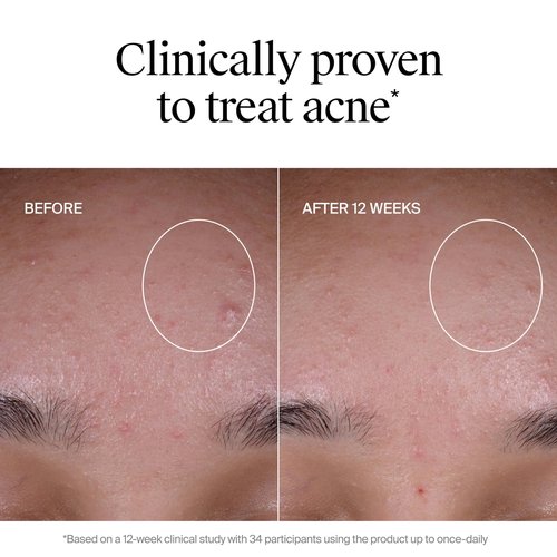 Neutrogena Evenly Clear Acne Exfoliant with Salicylic Acid & Mandelic Acid, Multi-Acid Face Exfoliating Treatment Serum Visibly Fade the look of Post-Acne Marks for A Smooth, Even Skin Tone, 1 fl. oz