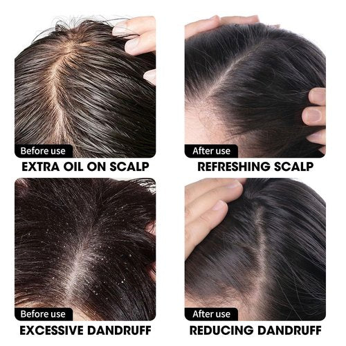 Regine Switzerland Anti Dandruff Shampoo - Deep Cleansing & Sebum Control - 16.8 fl. oz for Men & Women