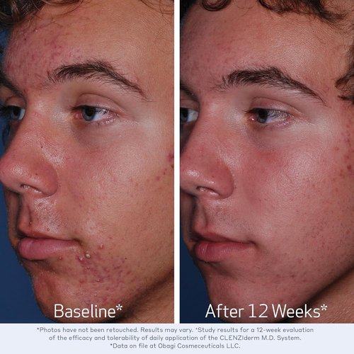 Obagi CLENZIderm M.D. Acne Cleanser - Daily Foaming Treatment with 2% Salicylic Acid (BHA)