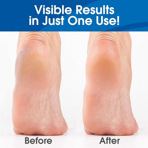 DeEnti Callus Remover Gel - Extra Strength 8oz for Dry Skin & Cracked Heels | Professional Foot Care