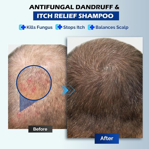 Skiennix Antifungal Psoriasis Shampoo - Relieves Scalp Itching & Dryness | 10.1 Fl Oz, Sulfate-Free