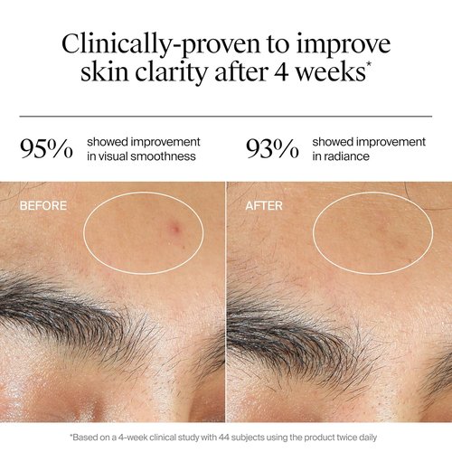 Neutrogena Evenly Clear Acne Gel Moisturizer - Lightweight Salicylic Acid Formula for Breakout Treatment | 1.7 fl. oz