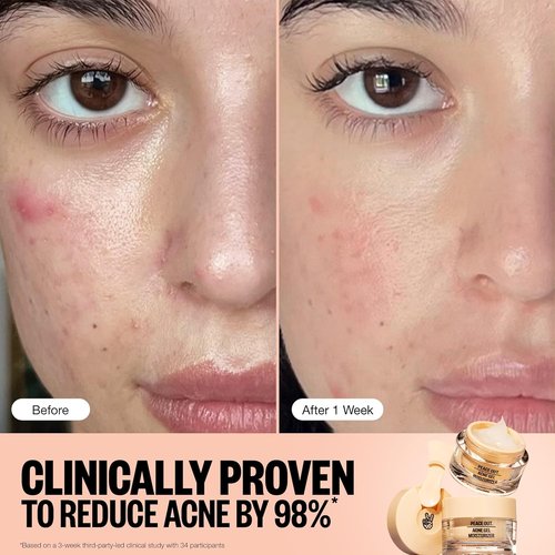 Peace Out Acne Gel Moisturizer - Oily Skin Face Cream with 2% Salicylic Acid & Niacinamide | 1.69 fl oz