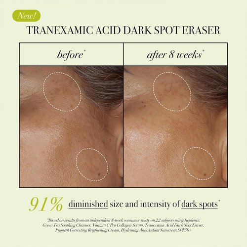 Replenix Tranexamic Acid Dark Spot Treatment - Daily Medical-Grade Serum for Uneven Skin Tone | 0.5 oz
