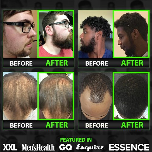 Beard Growth Serum by GROW | Maximum XXL Beard Oil for Men - Thickens & Fills Patches
