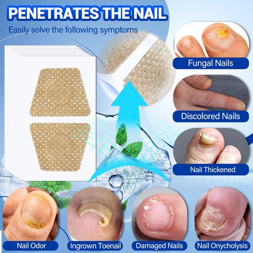 Skiennix Toenail Fungus Treatment - 50 Extra Strength Hydrogel Nail Patches for Overnight Repair