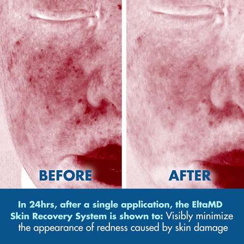 EltaMD Skin Recovery System - 3-Piece Facial Care Set with Gentle Essence Toner, Serum & Moisturizer