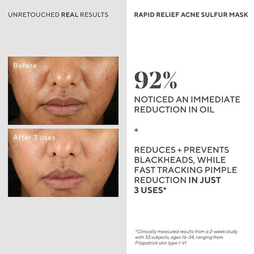 Murad Rapid Relief Acne Sulfur Mask - Clay Mask with Salicylic Acid & 5% Sulfur | Reduces Breakouts & Unclogs Pores - 2.5 Fl Oz