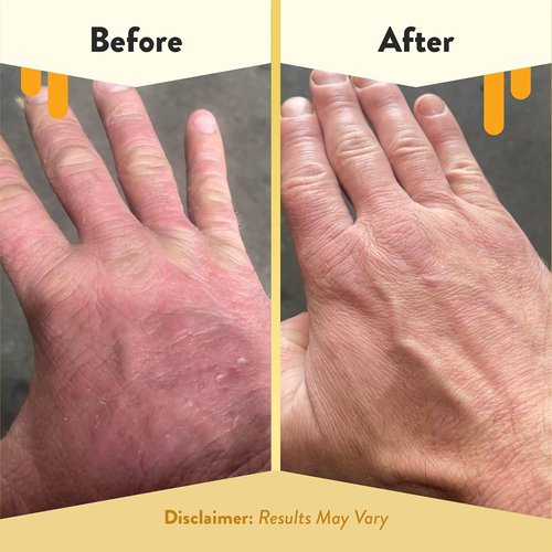 ECZEMA HONEY Gentle Foaming Hand Soap - Non-Toxic, Unscented Cleanser for Dry Hands - Organic Honey Handwash (8.4 Oz)