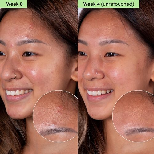 Sand & Sky Blemish Clearing Clay Face Mask - Oil Control with Salicylic Acid & Niacinamide, Minimizes Redness & Tightens Pores