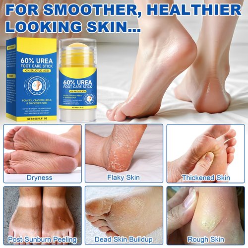 60% Urea Cream Stick with 2% Salicylic Acid, Maximum Strength Urea Foot Cream for Dry Cracked Heels, Callus Remover, Rapidly Softens the Hardest, Thickest Skin. Visible Smoothness in Days, Non-Greasy
