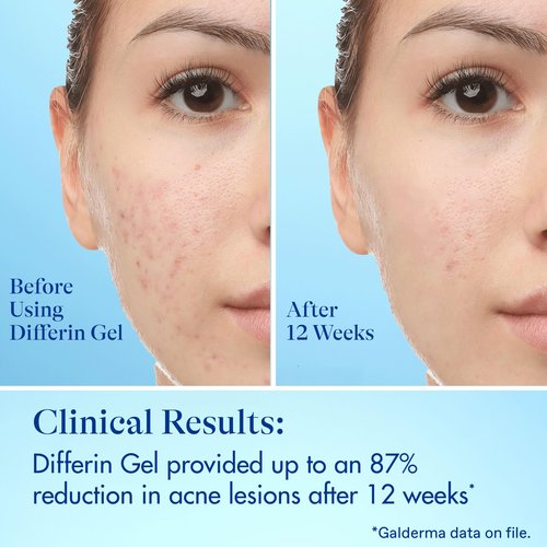 Differin Acne Fighter Pack, Differin Gel Retinoid Acne Treatment For Face with 0.1% Adapalene, 15g Tube + Salicylic Acid Pimple Patches, 36 Count, Designed for Pimple and Acne-Prone Skin