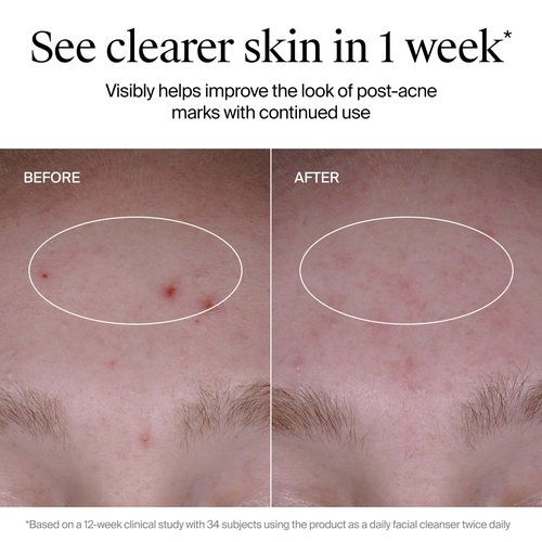 Neutrogena Evenly Clear Acne Cleanser with 2% Salicylic Acid & 2% PHA Exfoliant, Gentle Foaming Face Wash Clears Clogged Pores & Blackheads While Visibly Fading Look of Post-Acne Marks, 9.1 fl. oz