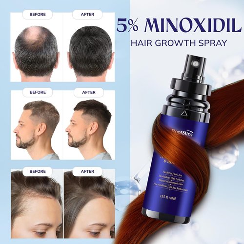 5% Minoxidil Hair Growth Serum - Extra Strength Treatment for Men & Women | 2-Pack, 60ML Each