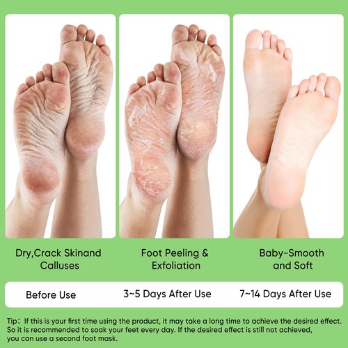 Berlaney Aloe Vera Foot Peeling Mask, Baby Feet Exfoliating Peel for Dead Skin Removal& Moisturizing Care, Dry Cracked Heels Relief, Softening Rough Feet Spa Socks, 3 Pairs Pack(Unisex)