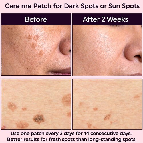 Care Me Microdart Dark Spot Patch - 127 Micropoints for Fading Acne Marks & Dark Spots | 9 Patches