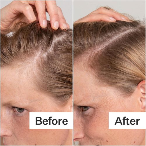 Act+ Acre Cold Processed Salicylic Acid Exfoliator - Balance & Soothe Scalp Build-Up | 2 Fl Oz