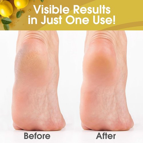 DeEnti Callus Remover Gel - Extra Strength 8oz for Dry Skin & Cracked Heels | Salon-Grade Foot Care