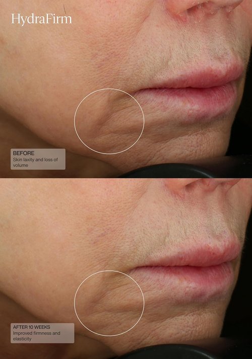 Senté HydraFirm Serum - Boosts Collagen & Elastin Production | Restores Firmness & Plumps Skin | 1 Fl Oz
