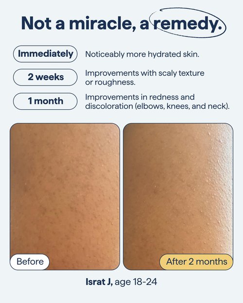 Remedy for Body Bumps | KP Exfoliating Body Moisturizer | Keratosis Pilaris (KP) Treatment For Textured, Crepey Skin with Urea, Lactic Acid, Retinol | Smoothing Body Lotion | By Dermatologist Dr. Shah