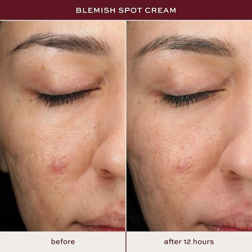 ITK Skincare Salicylic Acid Acne Spot Treatment - Fast Relief for Face, Back & Body | 0.5oz with Tea Tree Oil