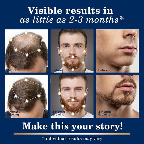 Regine Switzerland Minoxidil Hair Growth Spray Kit - Extra Strength Treatment for Thinning Hair & Beard - 2PCS