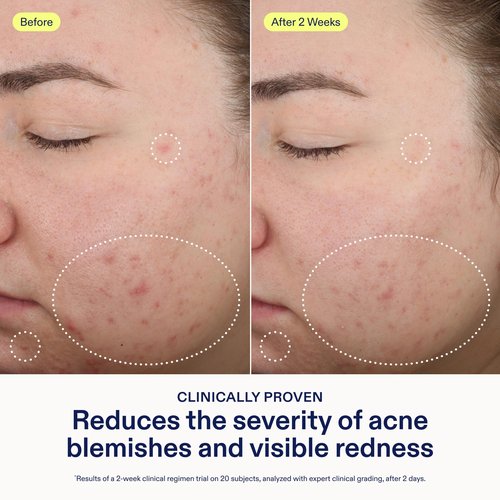 Skinfix 2% BHA Spot Treatment - 0.5 fl oz - Clears Acne Blemishes & Blackheads with Niacinamide - Fragrance Free - Vegan, Cruelty Free