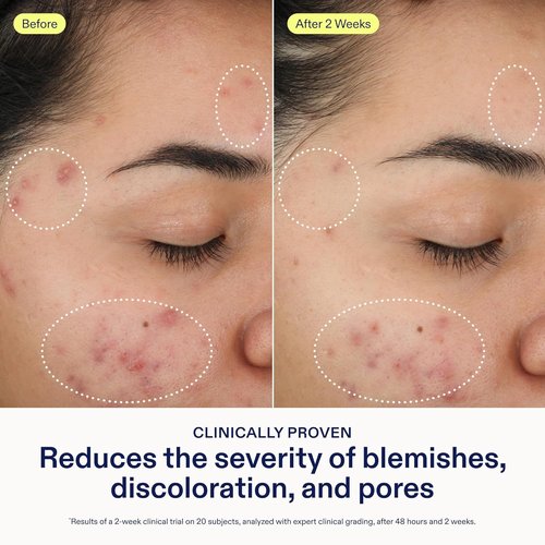 Skinfix 2% BHA Cleanser - Clears Acne Blemishes & Blackheads - 1 oz - Fragrance-Free, Vegan & Cruelty-Free