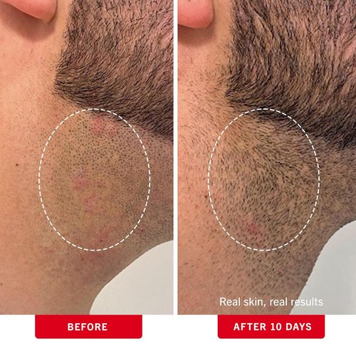 First Aid Beauty - Ingrown Hair Treatment Pads with BHA + AHA - Prevent Razor Bumps for Men & Women | 28 Compostable Pads