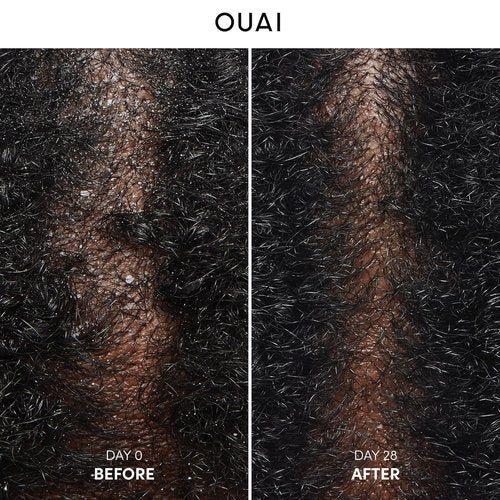 OUAI Anti Dandruff Shampoo - Soothing Salicylic Acid Formula for Flaky Scalp - Sulfate Free (10 Fl Oz)