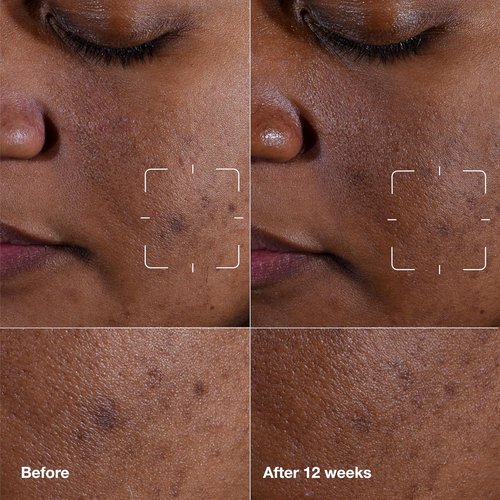 Clinique Even Better Clinical Dark Spot Clearing Serum - Brightening & Soothing for All Skin Types
