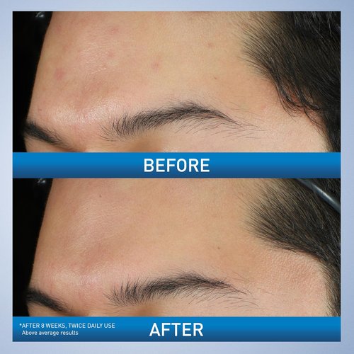 CeraVe Acne Foaming Cream Wash - Gentle Face & Body Cleanser with 10% Benzoyl Peroxide | 5 Oz