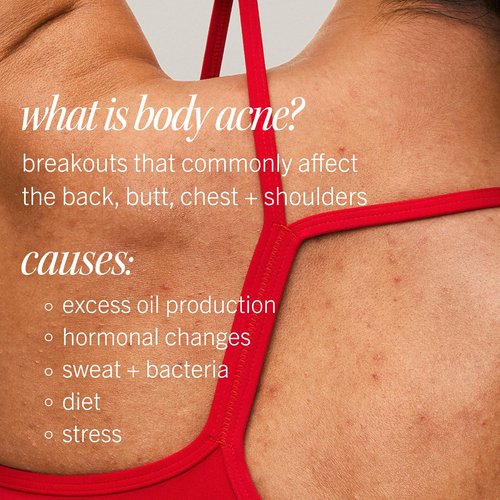 First Aid Beauty Body Acne Spray - Maximum Strength Body Acne Treatment With 360-Degree Sprayer - 2% Salicylic Acid Formula, (3.0 oz)