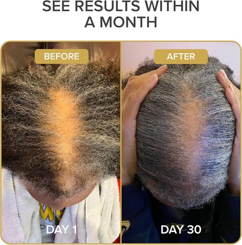 Shedavi Iconic Natural Hair Vitamins - Fast Hair Growth & Thicker Hair | Vegan Supplements (60 Capsules)