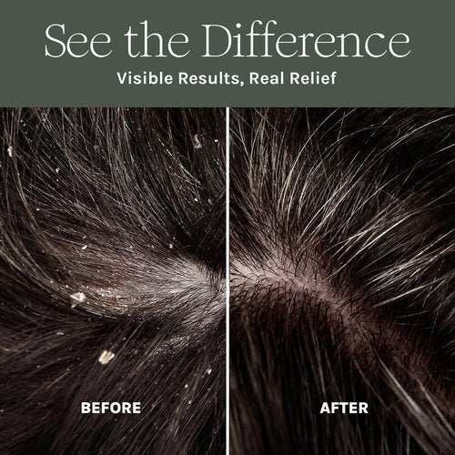 Purist Dandruff Spray - Leave-In Scalp Treatment for Itchy, Dry Skin | Hydrating & Soothing Moisturizer