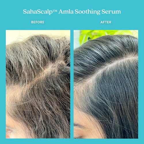 Fable & Mane Amla Soothing Serum - Purifies & Balances Irritation | Detox Treatment for Dry Scalps