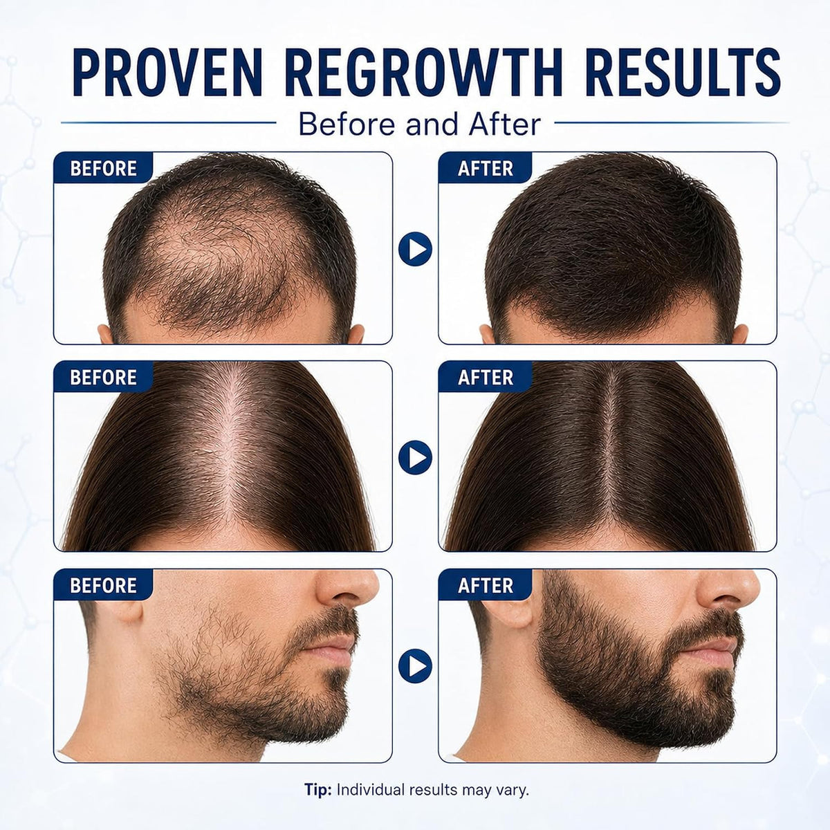Minoxidil Hair Regrowth Serum for Thinning Hair 3-Pack - Supports Fuller Hair