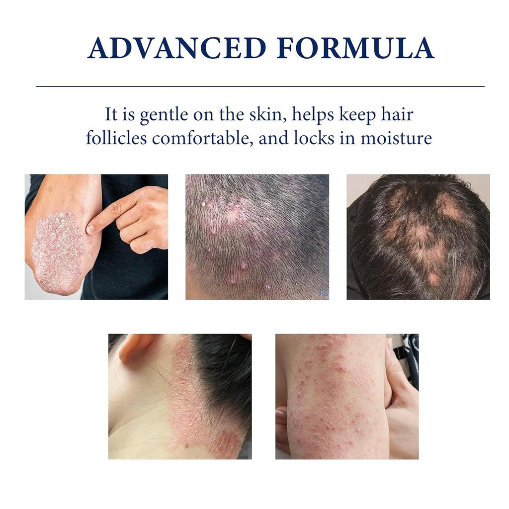 Folliculitis Soothing Cream for Scalp, Face, Body – Non Comedogenic Balm 4.23oz