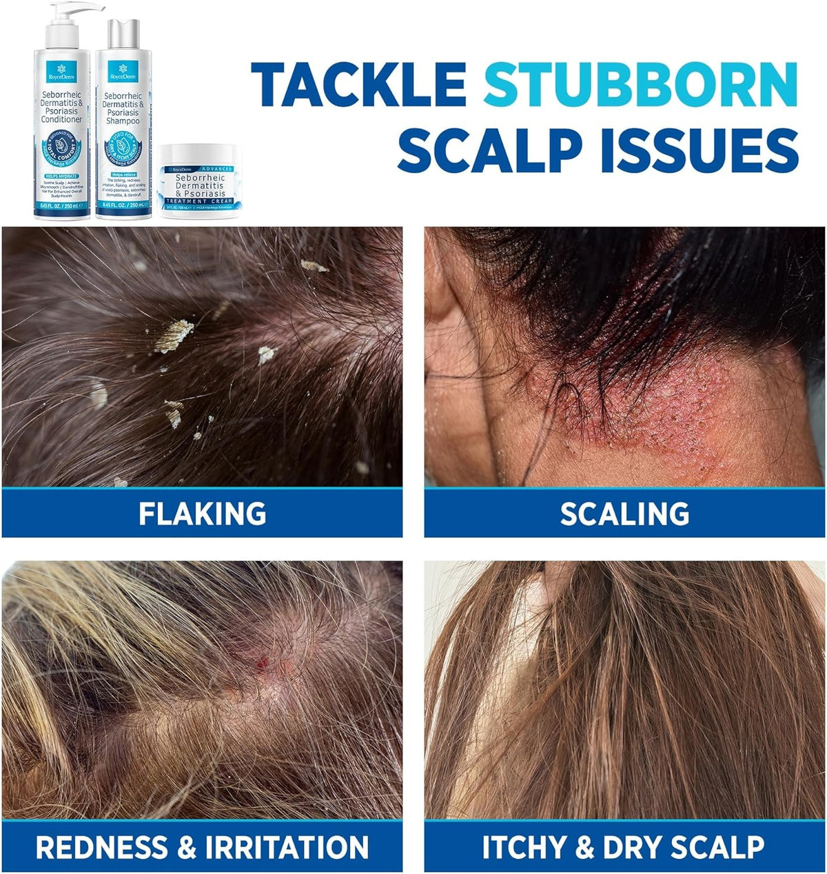 Seborrheic Dermatitis & Psoriasis Care Set - Shampoo, Conditioner & Cream for Scalp Relief