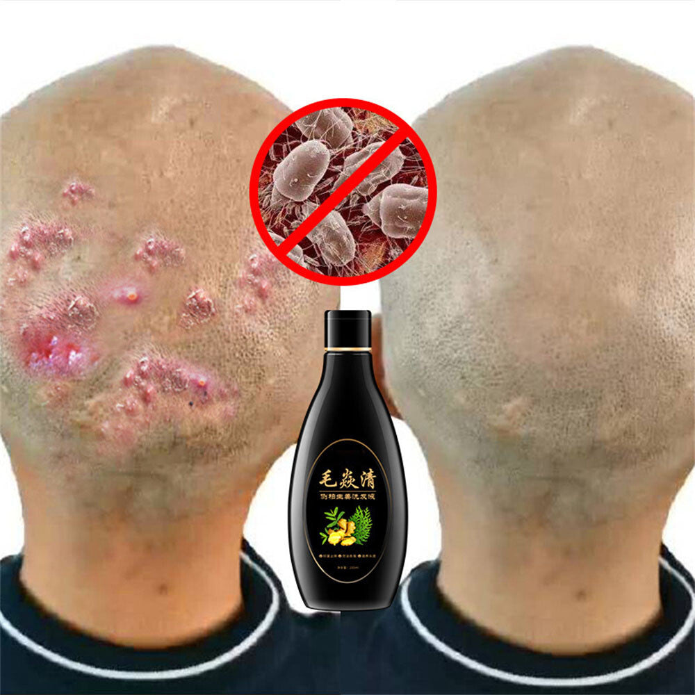 Natural Scalp & Hair Follicle Shampoo for Dandruff Itching Oil Control 200ml