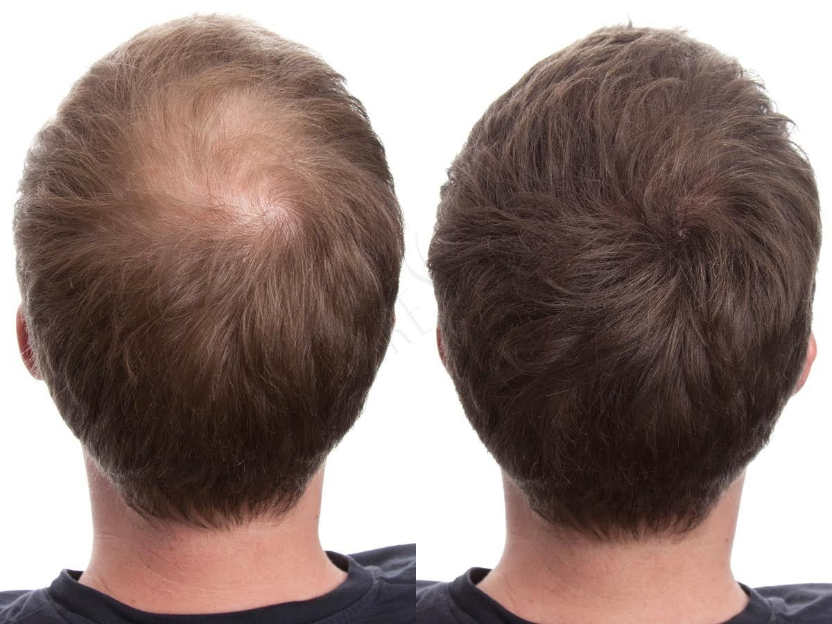 Hair Loss Prevention Shampoo 8.5 oz Supports Strong, Healthy Hair
