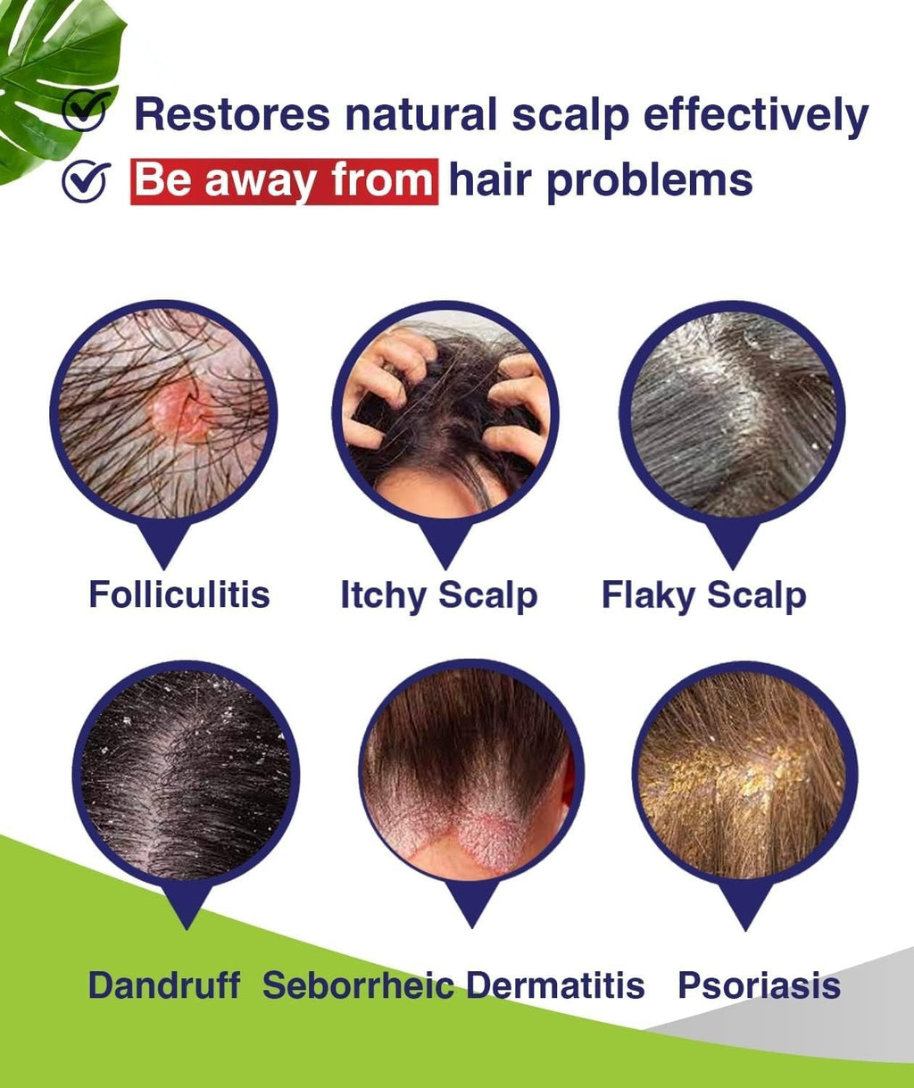 Anti-Fungal Shampoo for Folliculitis & Psoriasis - Soothes Dry Scalp Relief