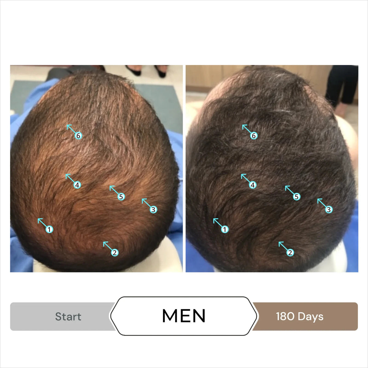 Hair Serum with Nanoxidil 5% for Hair Density & Thickness - 3 Month Supply