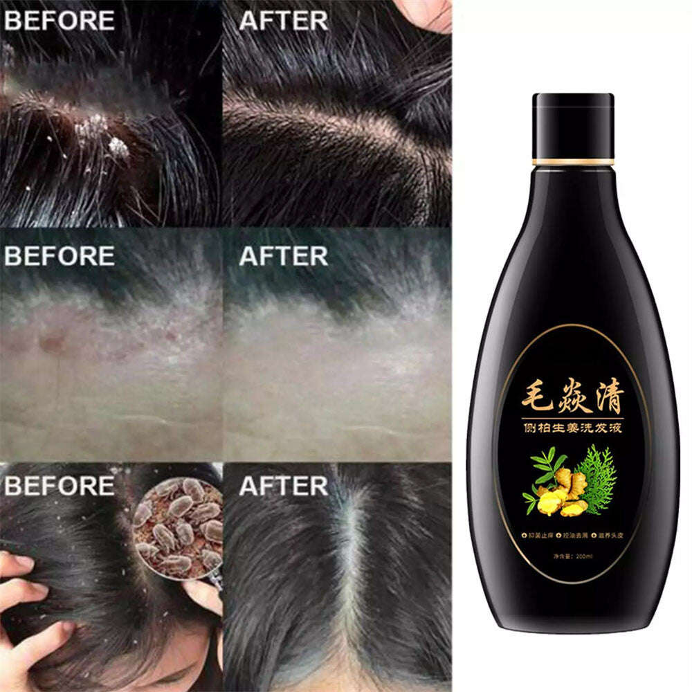 Natural Scalp & Hair Follicle Shampoo for Dandruff Itching Oil Control 200ml
