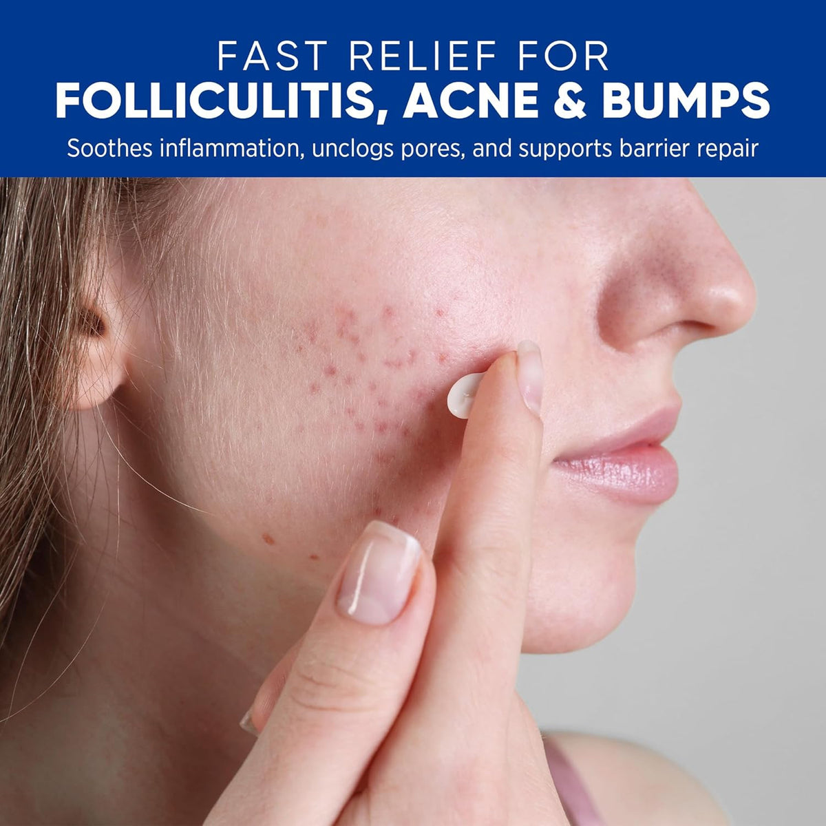 Folliculitis & Acne Treatment Cream with Salicylic Acid and Herbal Extracts for Scalp, Face, Body