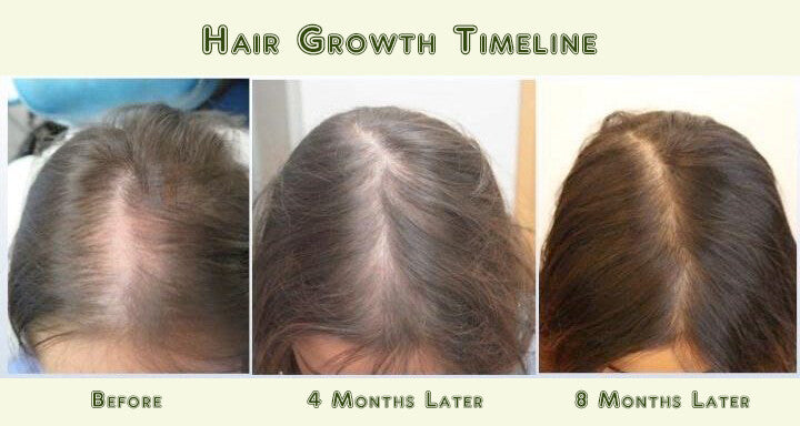 Hair Loss Treatment Kit for Men & Women | Organic DHT Blocker & Regrowth Support