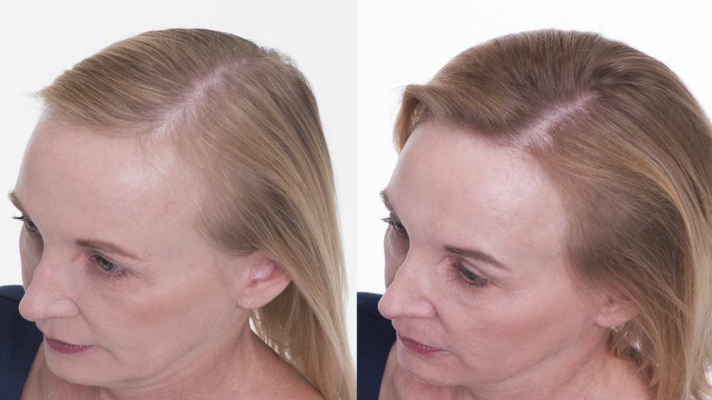 Hair Loss Treatment Kit for Men & Women | Organic DHT Blocker & Regrowth Support