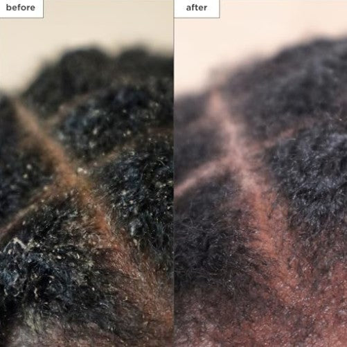 Scalp Treatment Serum with Charcoal and Tea Tree for Hair Care - Leave-In