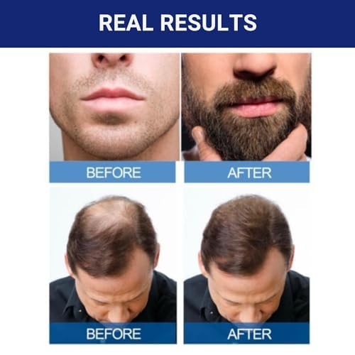 Men's 5% Minoxidil Hair Regrowth Treatment - 2oz with Easy Drop Application