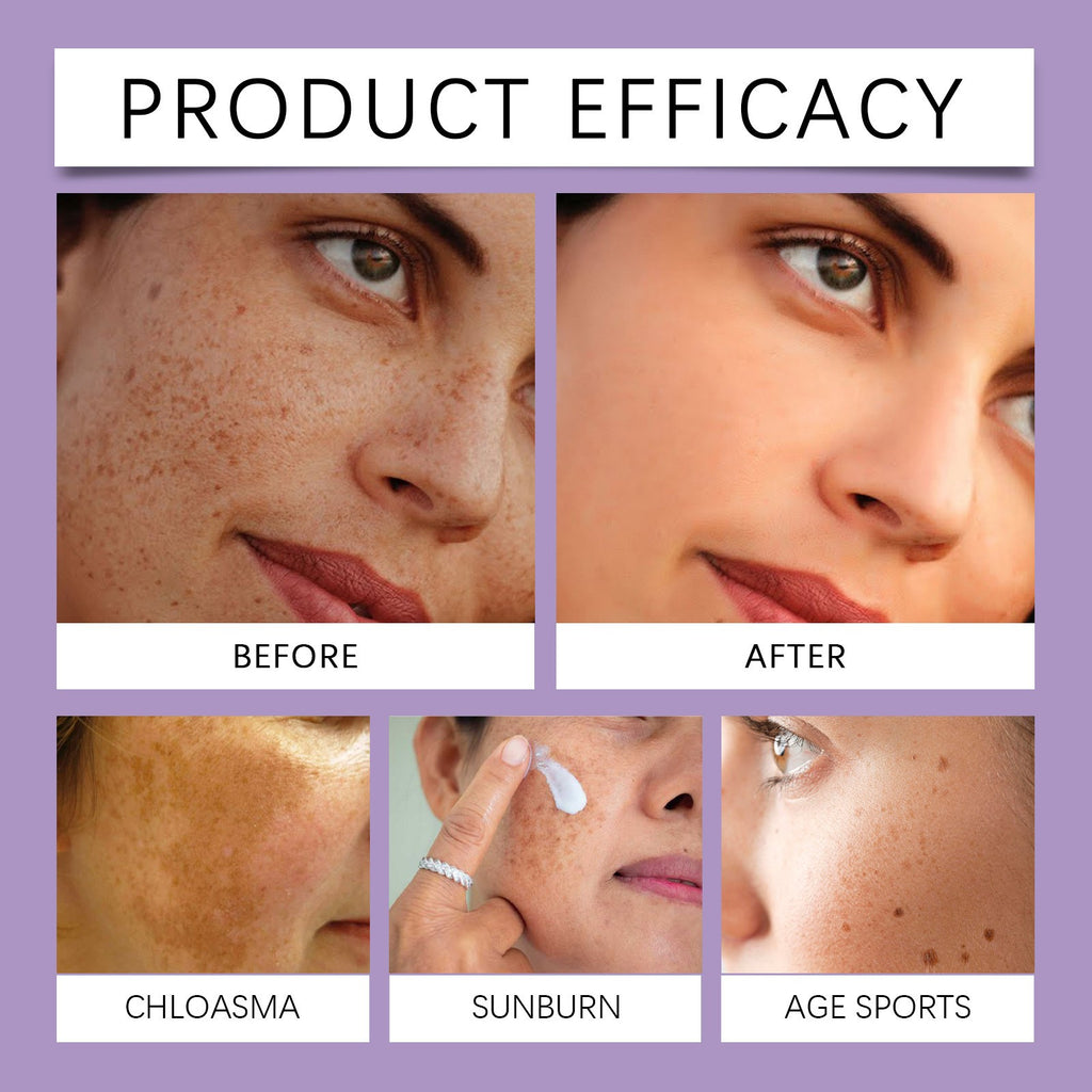 Anti-Hyperpigmentation Cream with Retinol for Sensitive Skin - 30g